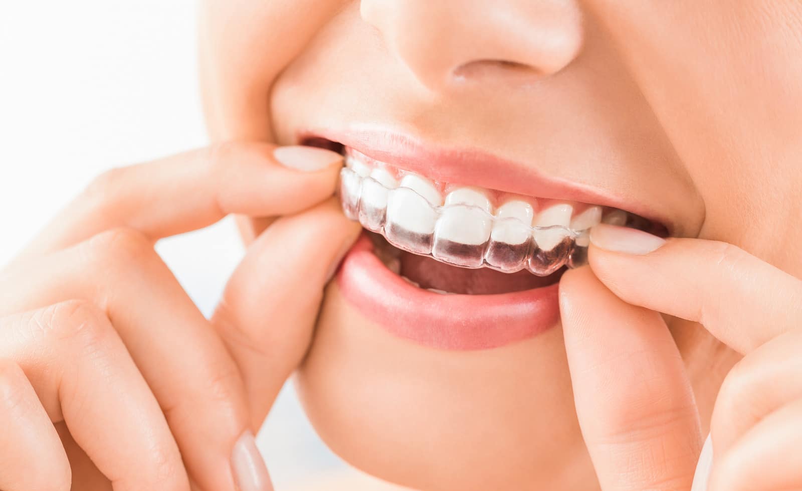 invisalign in houston tx, floss dental of houston midtown