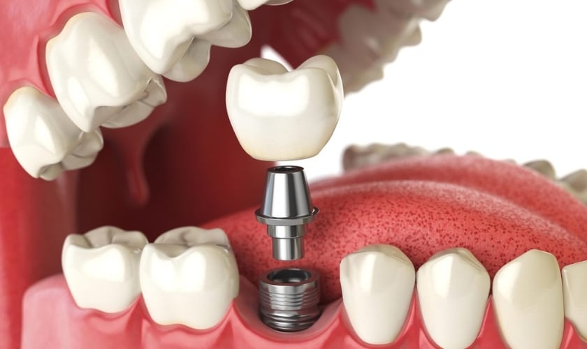 Caring for Your Dental Implants Tips for Long-Lasting Results